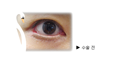 뒤트임흉, <a href=