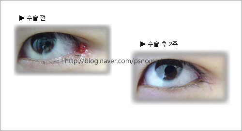 뒤트임 흉터를 없앨 수 있나요? - 뒷트임 흉, 뒤트임 흉터