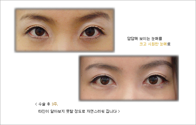 앞트임-- 흉터를 줄이며 눈이 커질려면