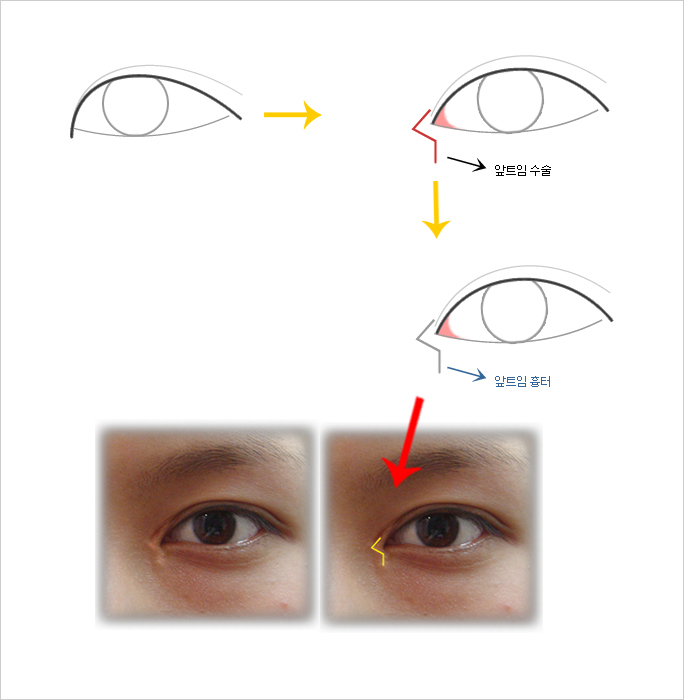 매직 앞트임, 무흉앞트임--- 예전의 앞트임보다 더 나은점은 뭘까 ?