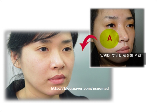 수술방법이 뭐에요?