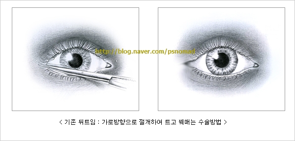 뒤트임 방법, 눈꼬리 내리기, 뒷트임
