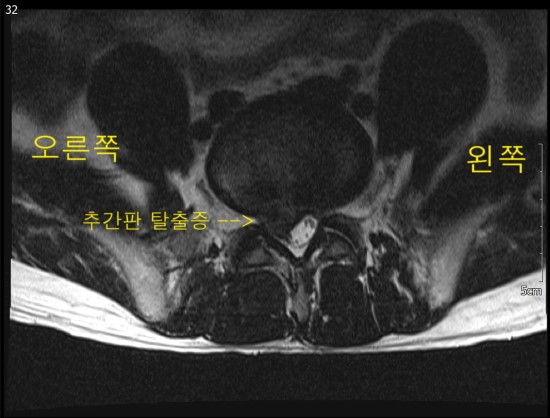 허리디스크 탈출증 - 허리 통증과 다리 저림의 가장 흔한 원인 : 네이버 블로그