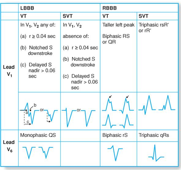 Brugada Criteria : 네이버 블로그