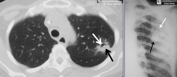 [전공의] Aspergilloma, Monod Sign : 네이버 블로그