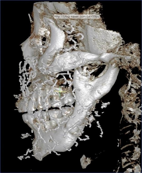 노이즈와 피부 삽입 물질이 함께 보이는 수술 전 측면 3D CT