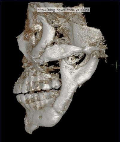 턱끝 이차각과 사각턱 과절제 후 하악각 소실이 보이는 측면 3D CT