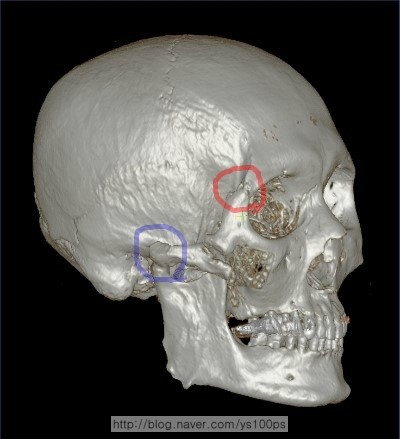 절골 흔적과 광대활 부정유합 부위를 표시한 오른쪽 사면 3D CT