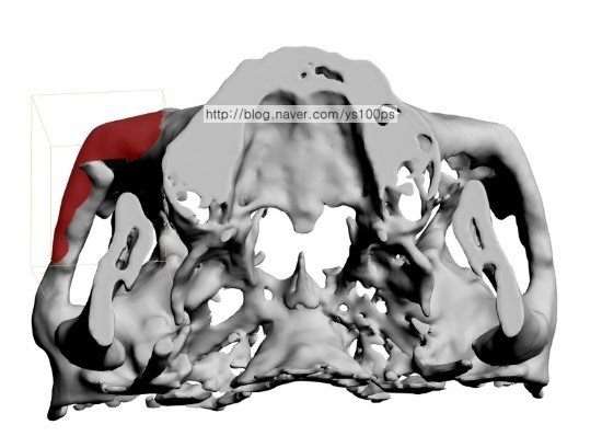 상악동 경계와 광대활 형태를 고려한 3D Fit 보형물 Arch View 설계