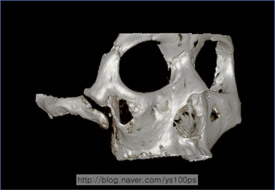 광대체부 골 결손과 광대 불유합이 보이는 오른쪽 사면 3D CT