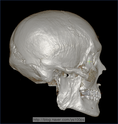 광대활 부정유합과 광대체부 골 결손이 보이는 오른쪽 측면 3D CT