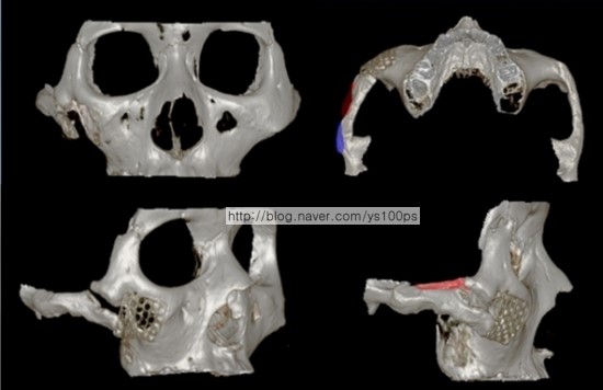 티타늄 3D Fit 광대 재건 수술 전 광대뼈 결손과 불유합 3D CT