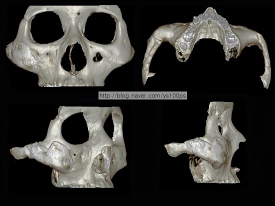 티타늄 3D Fit 맞춤 보형물로 광대뼈 결손을 재건한 수술 후 3D CT