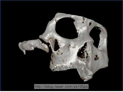 골 결손으로 상악동 경계가 열린 상태를 보여주는 사면 3D CT