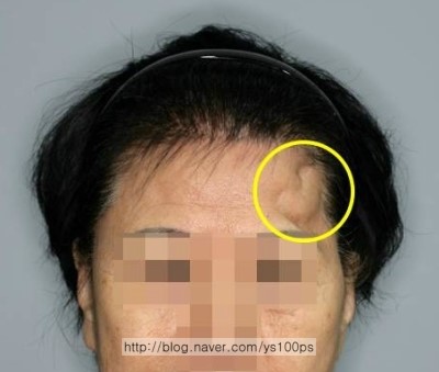 뇌수술 후 왼쪽 이마 함몰 부위를 표시한 환자 정면 사진