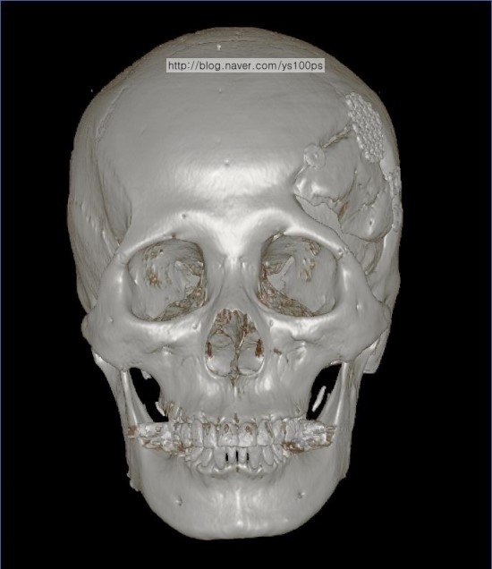왼쪽 이마와 측두골의 두개골 결손 및 골흡수가 보이는 정면 3D CT