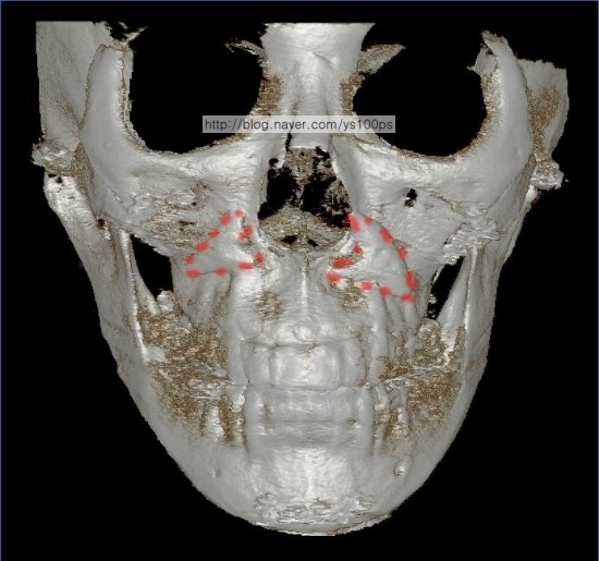 귀족수술 후 왼쪽 보형물이 아래쪽으로 이동해 잇몸 가까이 위치한 3D CT