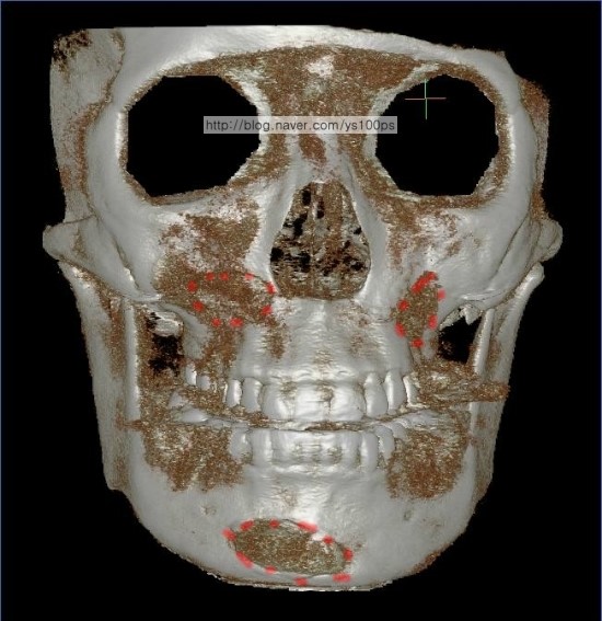 귀족수술 보형물의 좌우 비대칭과 턱끝 보형물의 이동이 보이는 3D CT