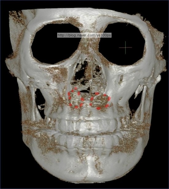 귀족수술 보형물이 중앙으로 이동하고 오른쪽 비공 안쪽으로 돌출된 3D CT