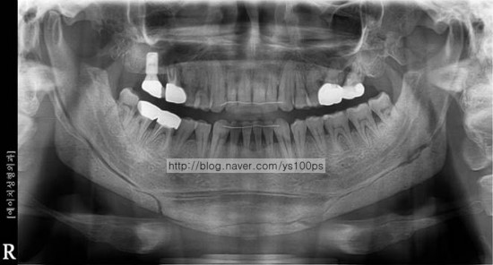 PMMA 3D Fit 보형물로 하악각과 턱끝을 재건한 수술 후 파노라마
