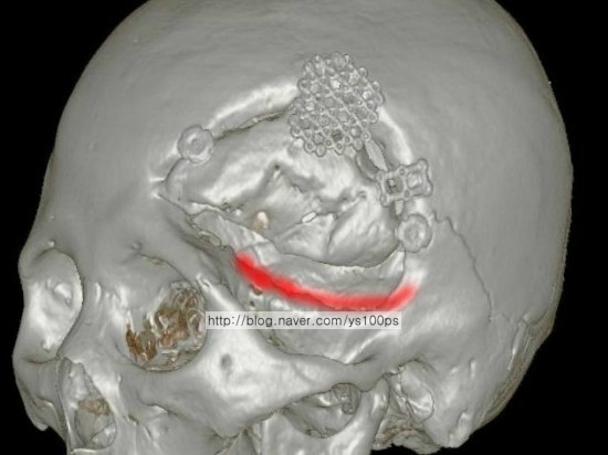 두개골 함몰과 수술 중 접근하기 어려운 결손 부위를 표시한 3D CT