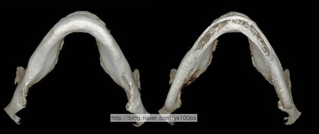 대칭적으로 재건된 양쪽 하악각과 앞쪽 사각턱 절제면을 비교한 아래쪽 3D CT