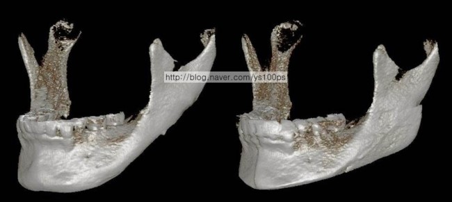 하악각 맞춤 재건과 턱끝 절골술 전후를 비교한 좌측 사면 3D CT