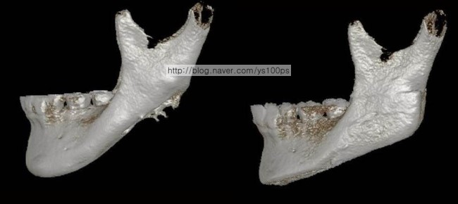 하악각 재건과 턱끝 절골술 전후를 비교한 좌측 측면 3D CT