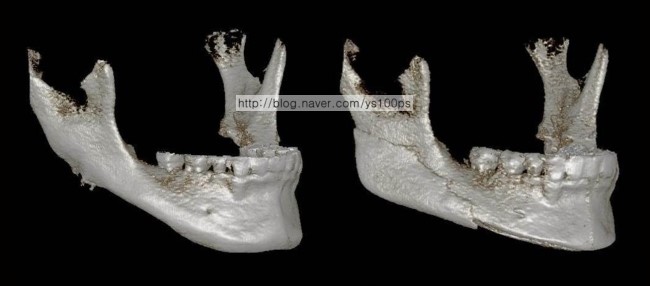 과절제된 하악각의 3D프린팅 재건 전후를 비교한 우측 사면 3D CT