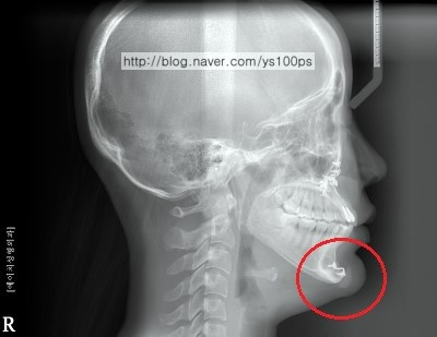 턱끝 전진술 고정 금속과 실리콘 보형물이 함께 보이는 측면 엑스레이