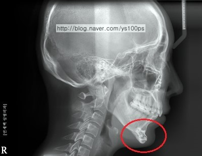턱끝 전진보다 하방 연장이 두드러진 측면 엑스레이