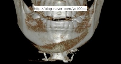 턱끝 보형물의 심한 반시계 방향 회전을 보여주는 3D CT