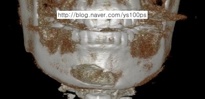 고어텍스 보형물의 우측 변위와 회전 및 상방 이동을 보여주는 3D CT