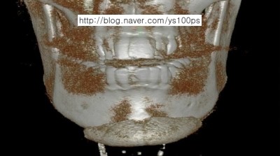 실리콘 턱끝 보형물의 반시계 방향 회전을 보여주는 3D CT