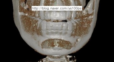 턱끝 보형물의 상방 이동을 정면에서 보여주는 3D CT