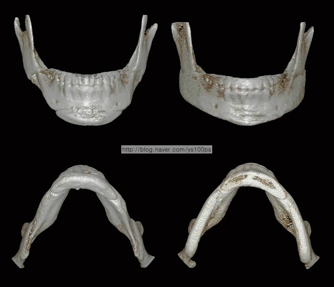사각턱 피질골 과절제와 턱끝 재수술 전후를 비교한 3D CT