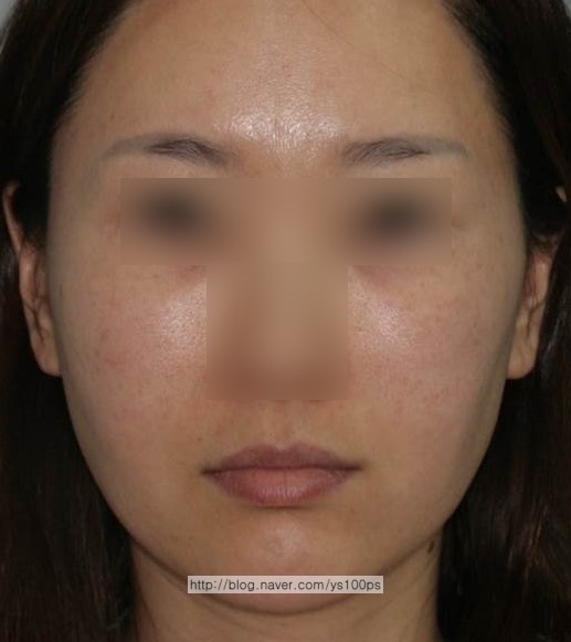 눈꼬리와 입꼬리 높이 차이를 보이는 안면비대칭 정면 사진