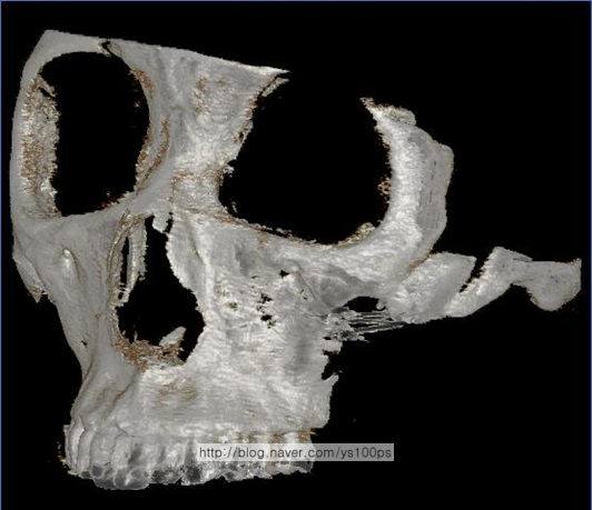 두 차례 광대수술 후 두 개의 절골선과 골 손실 및 함몰을 보여주는 좌측 3D CT