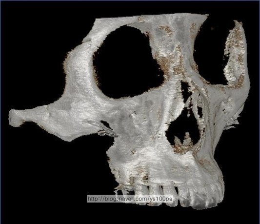 비교적 연속적인 골격 윤곽을 보이는 우측 광대 3D CT