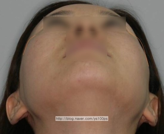 아래쪽에서 본 좌우 광대 폭 차이와 좌측 광대 함몰 부위를 보여주는 사진