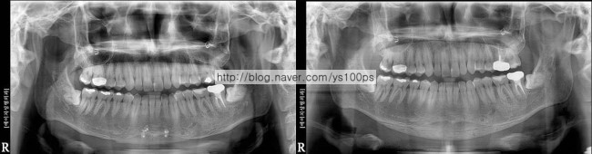 남아 있는 턱뼈와 3D Fit PMMA 보형물의 경계를 보여주는 파노라마 엑스레이