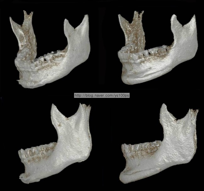 좌측 턱끝 절골 후 이차각과 3D Fit PMMA 재건 전후를 비교한 3D CT