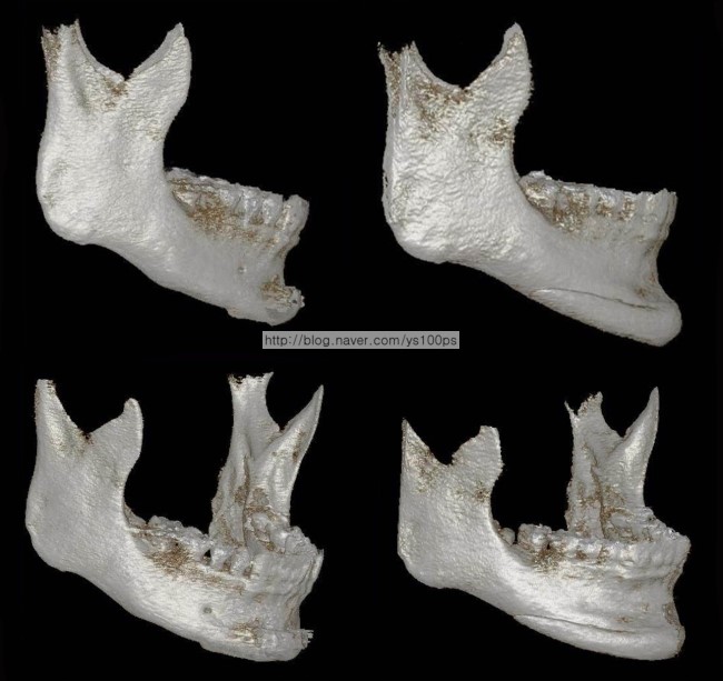 우측 턱끝 절골 후 짧아진 골격과 3D Fit PMMA 재건 전후를 비교한 3D CT