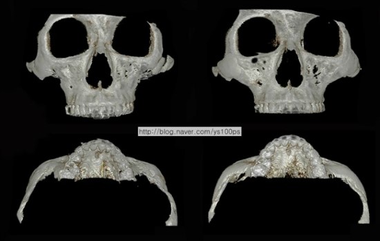 양측 광대 함몰을 3D Fit PMMA로 재건한 3D CT