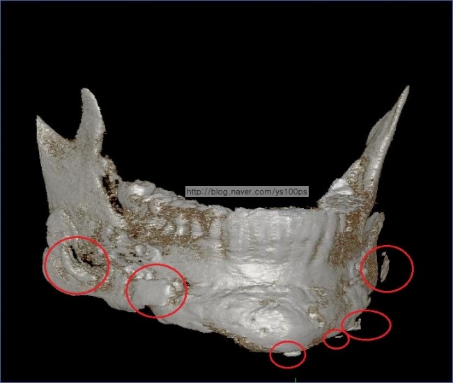 이전 사각턱 재건에 사용된 여러 본시멘트 조각을 보여주는 하악골 3D CT