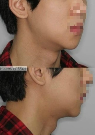 우측 하악각 함몰과 사각턱 과절제 재건 전후의 측면 얼굴 비교
