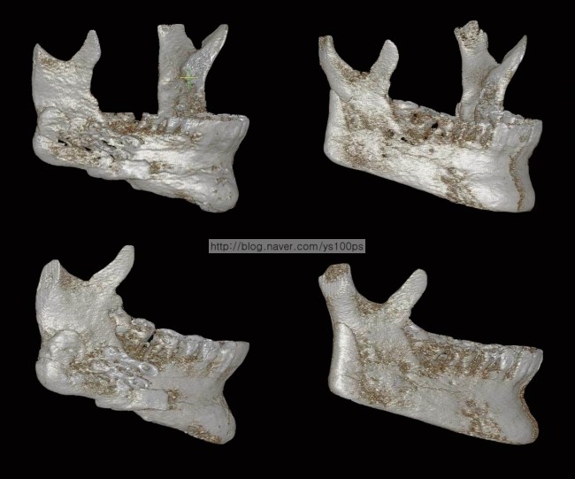 좌측 하악각의 기존 본시멘트 조각과 3D프린팅 기반 재건 결과를 비교한 3D CT
