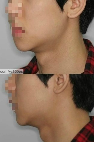 좌측 하악각 과절제와 개턱 형태 재건 전후의 측면 얼굴 비교