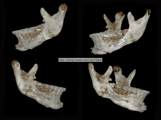 사각턱 재건 전 골격을 확인하기 위해 확보한 과거 양악수술 후 3D CT