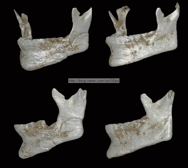 우측 하악각과 턱끝의 3D프린팅 기반 재건 전후를 비교한 3D CT